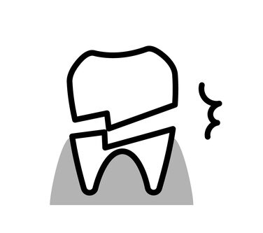 歯の怪我の治療法：歯が割れた│大府市の歯医者・大府東歯科