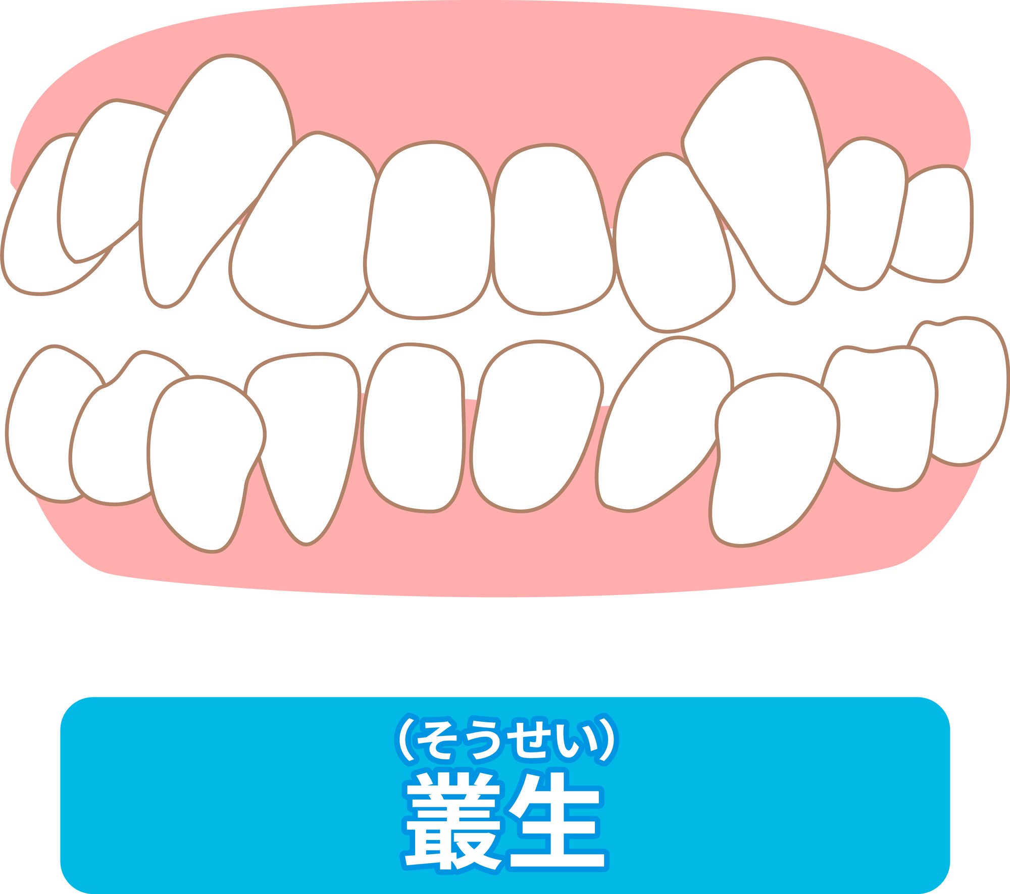 乱杭歯・八重歯（叢生）│大府市の歯医者・大府東歯科