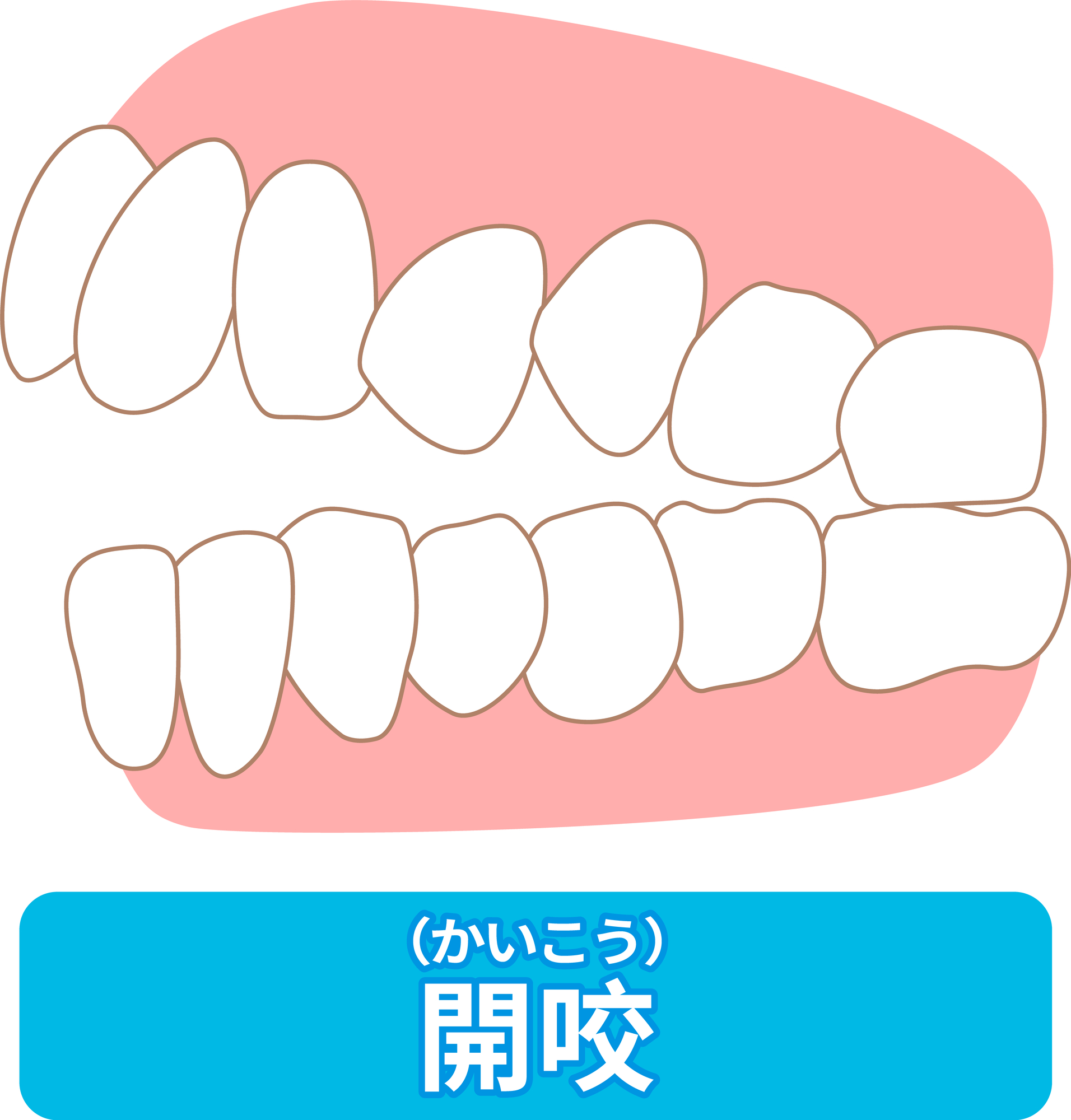 開咬│大府市の歯医者・大府東歯科