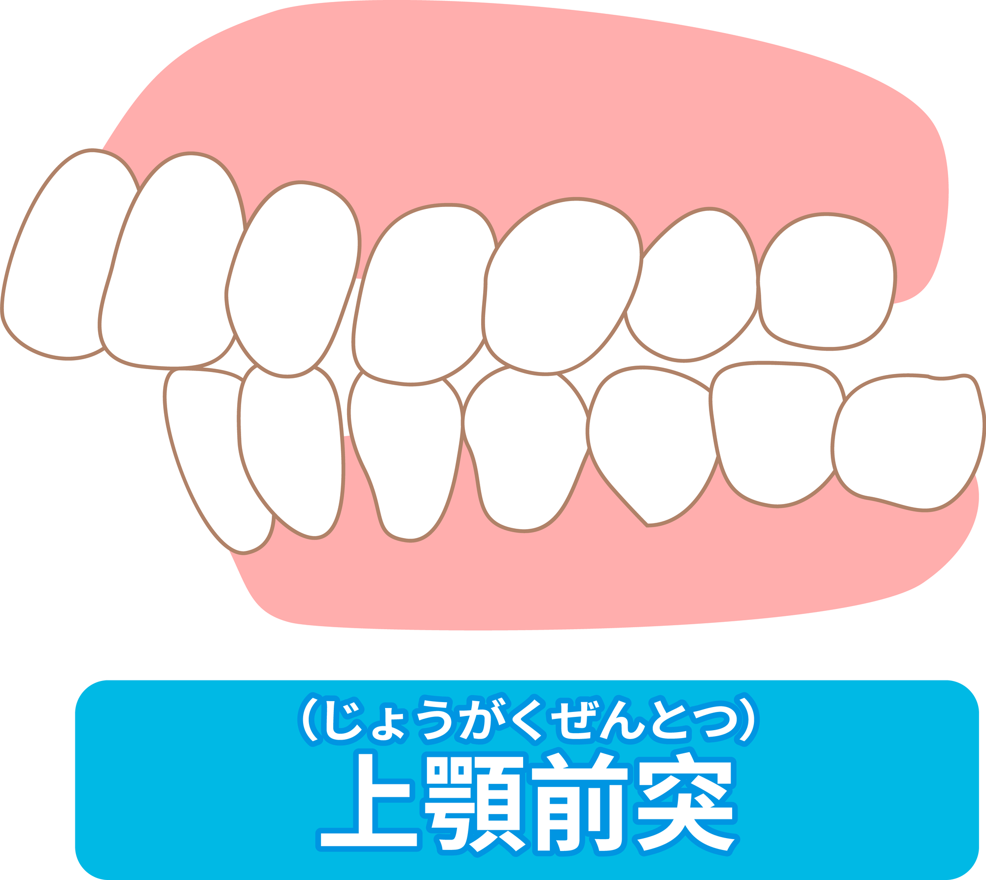 上顎前突│大府市の歯医者・大府東歯科