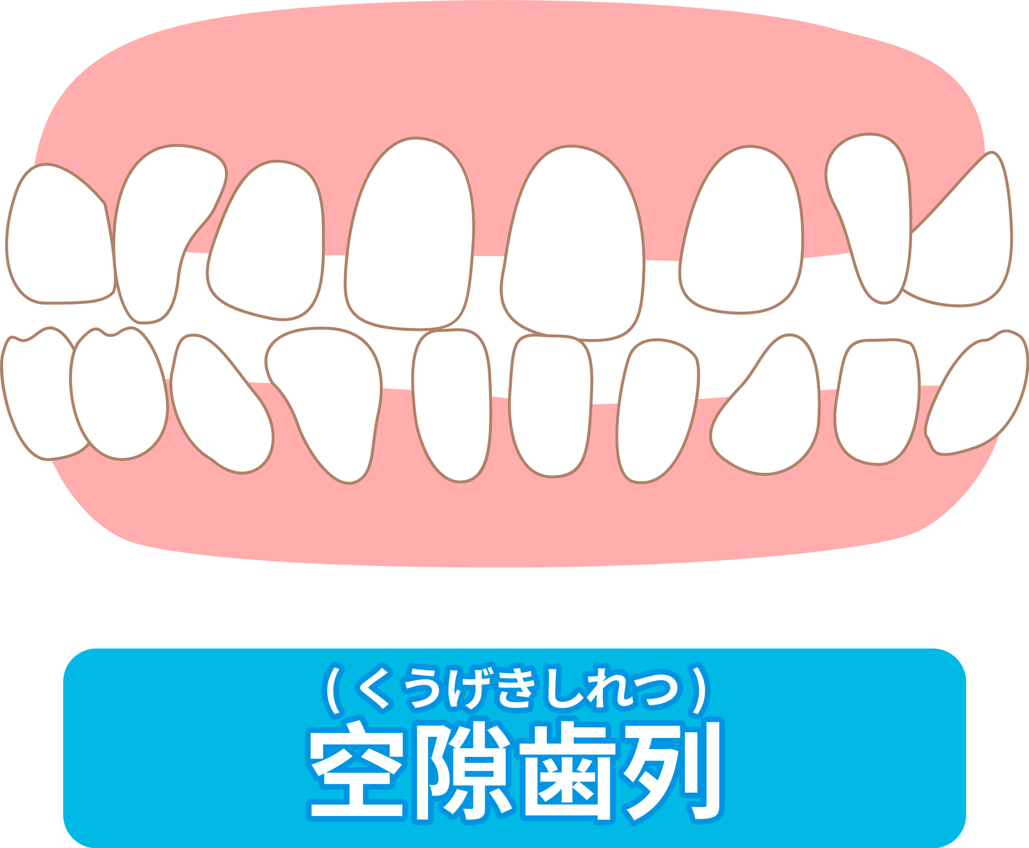 すきっ歯│大府市の歯医者・大府東歯科