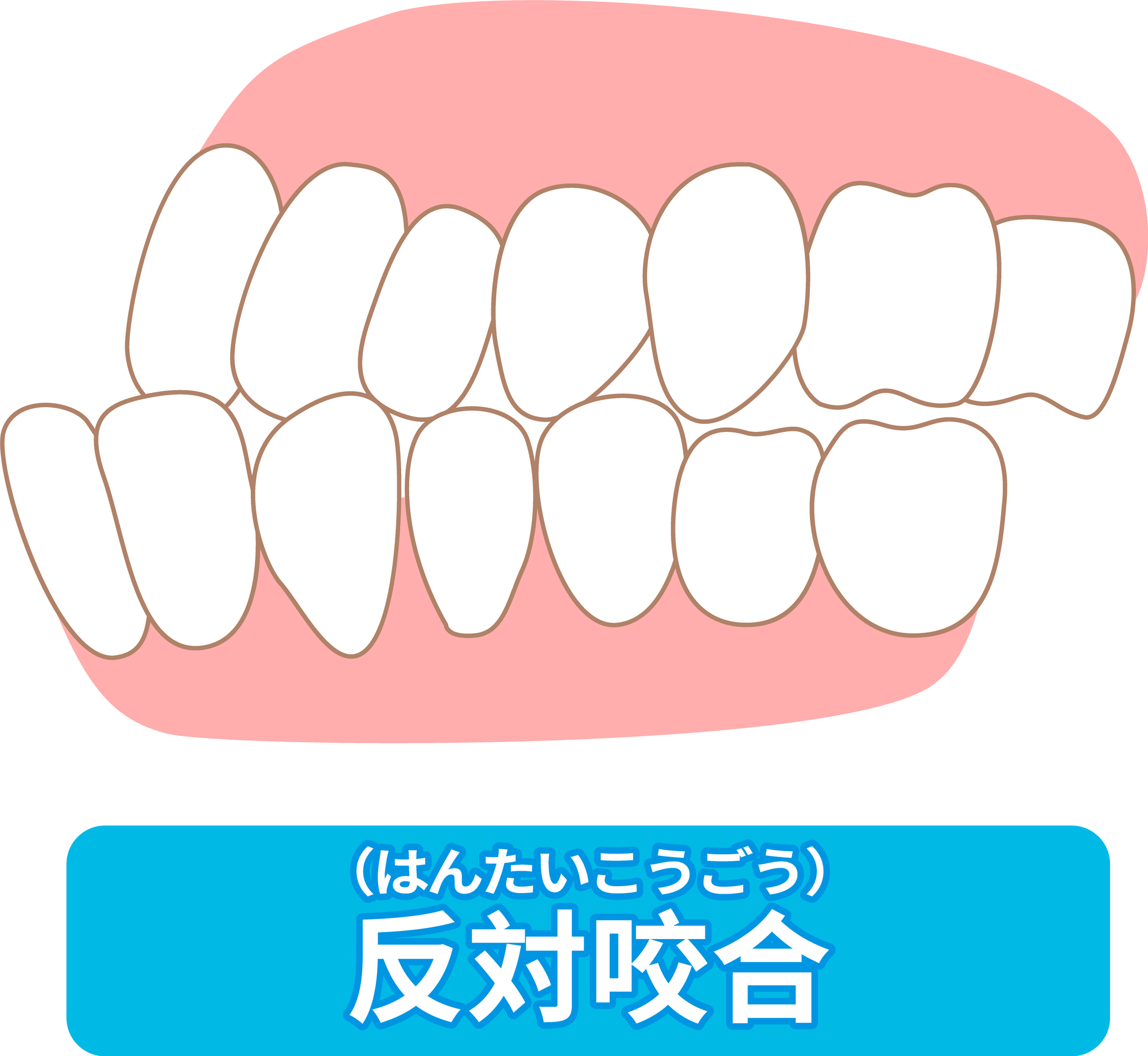 反対咬合│大府市の歯医者・大府東歯科