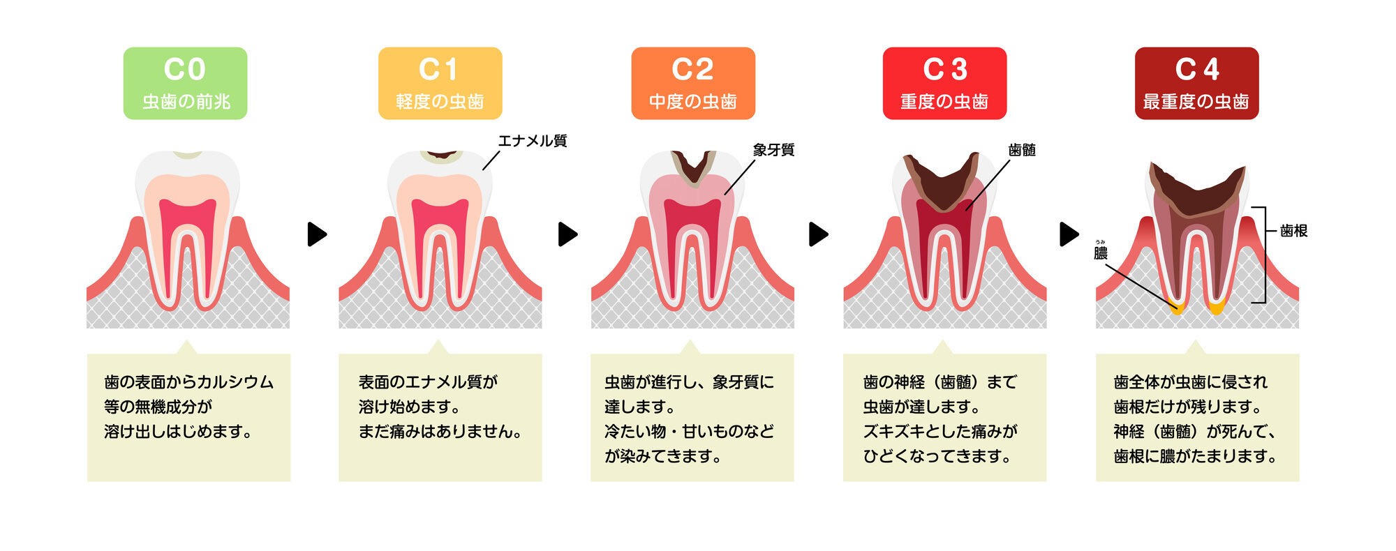 虫歯の進行度│大府市の歯科・大府東歯科