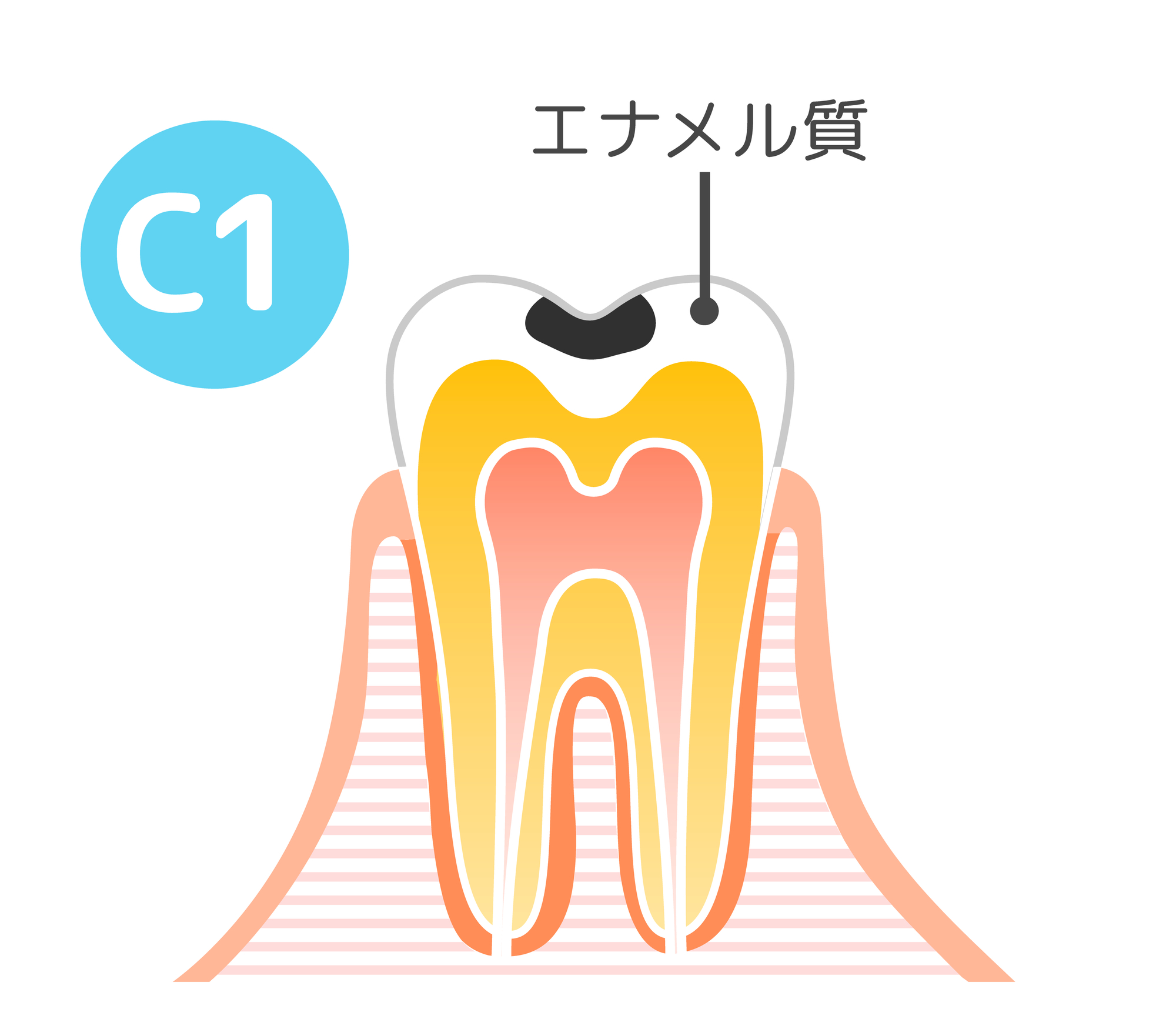 虫歯の進行度：C1│大府市の歯科・大府東歯科