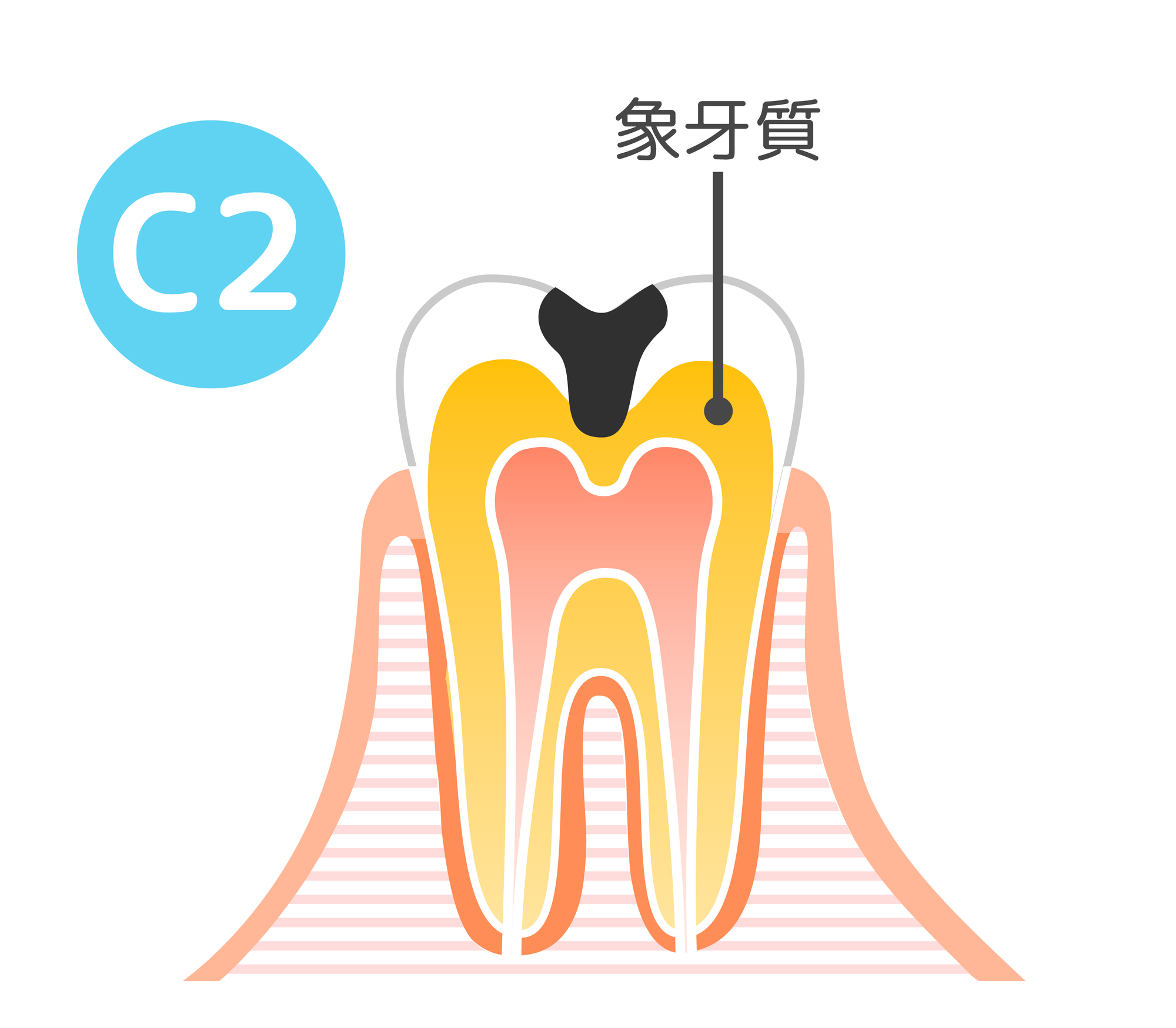 虫歯の進行度：C2│大府市の歯科・大府東歯科