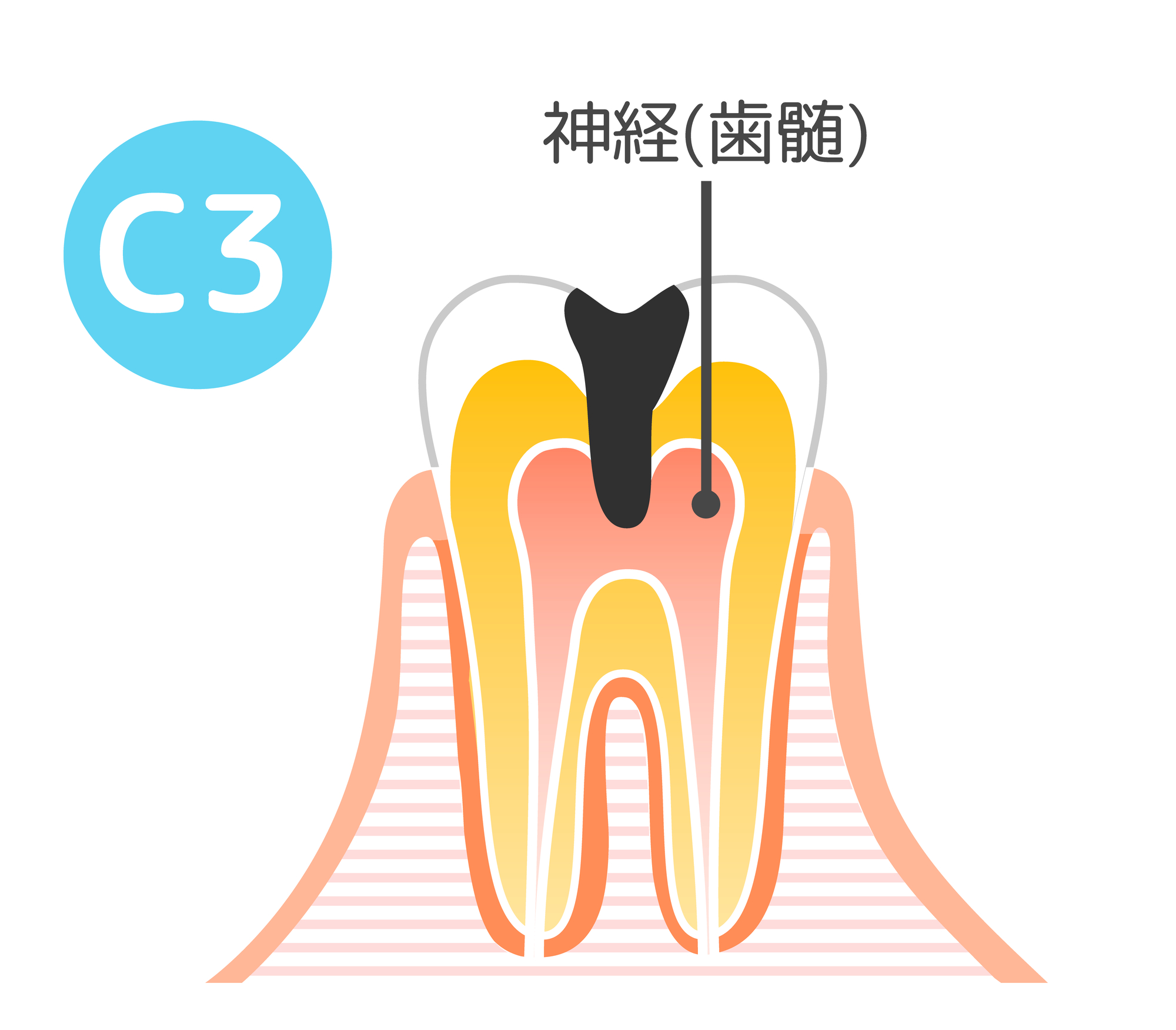 虫歯の進行度：C3│大府市の歯科・大府東歯科