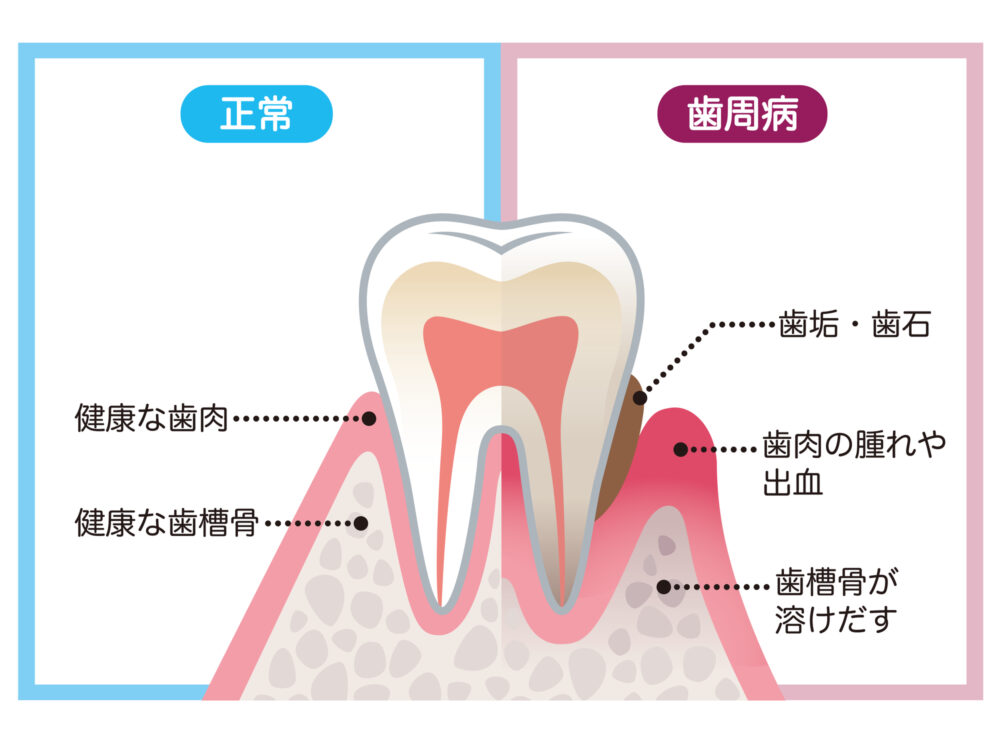 歯周病とは