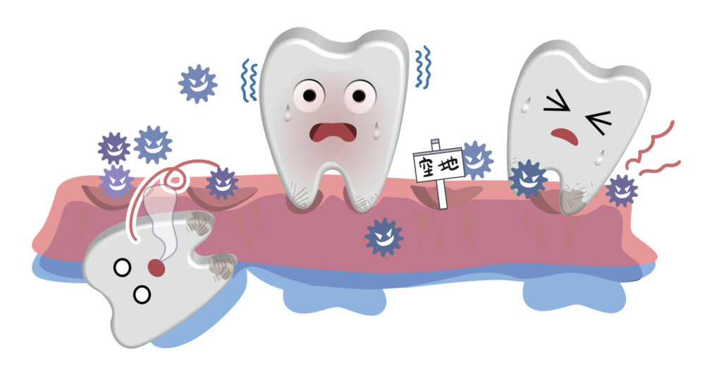 重度歯周病とは？早期治療が歯を守ります│大府市の歯医者・大府東歯科