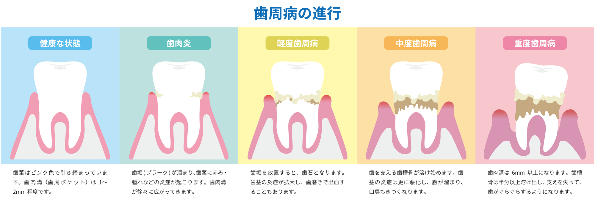 歯肉炎とは？歯周病との違いと進行段階